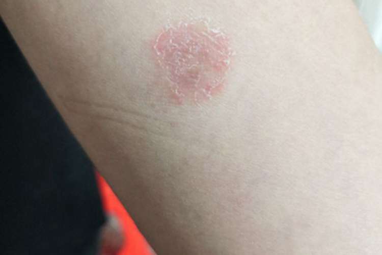 体癣胳膊症状图