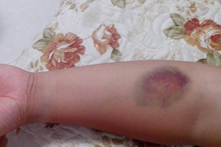 外伤手臂上有青紫块图 外伤手臂上有青紫块图