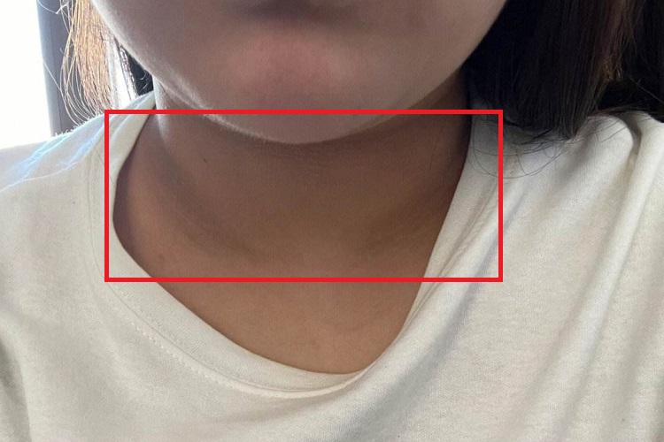 职业性皮肤色素变化前颈症状图