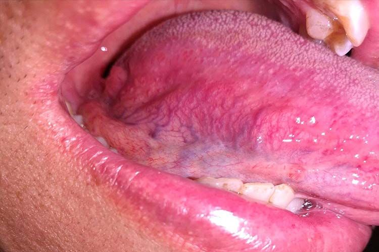 叶状乳头炎图 叶状乳头炎图