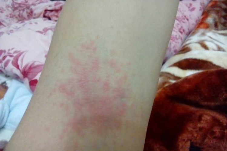 黄酒过敏红斑图 黄酒过敏红斑图