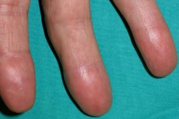 偶发分枝杆菌感染红肿图