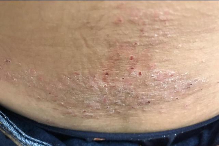 湿疹腰部脱皮图