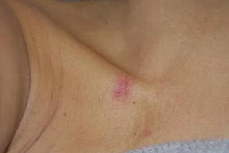 前胸部蜘蛛痣图