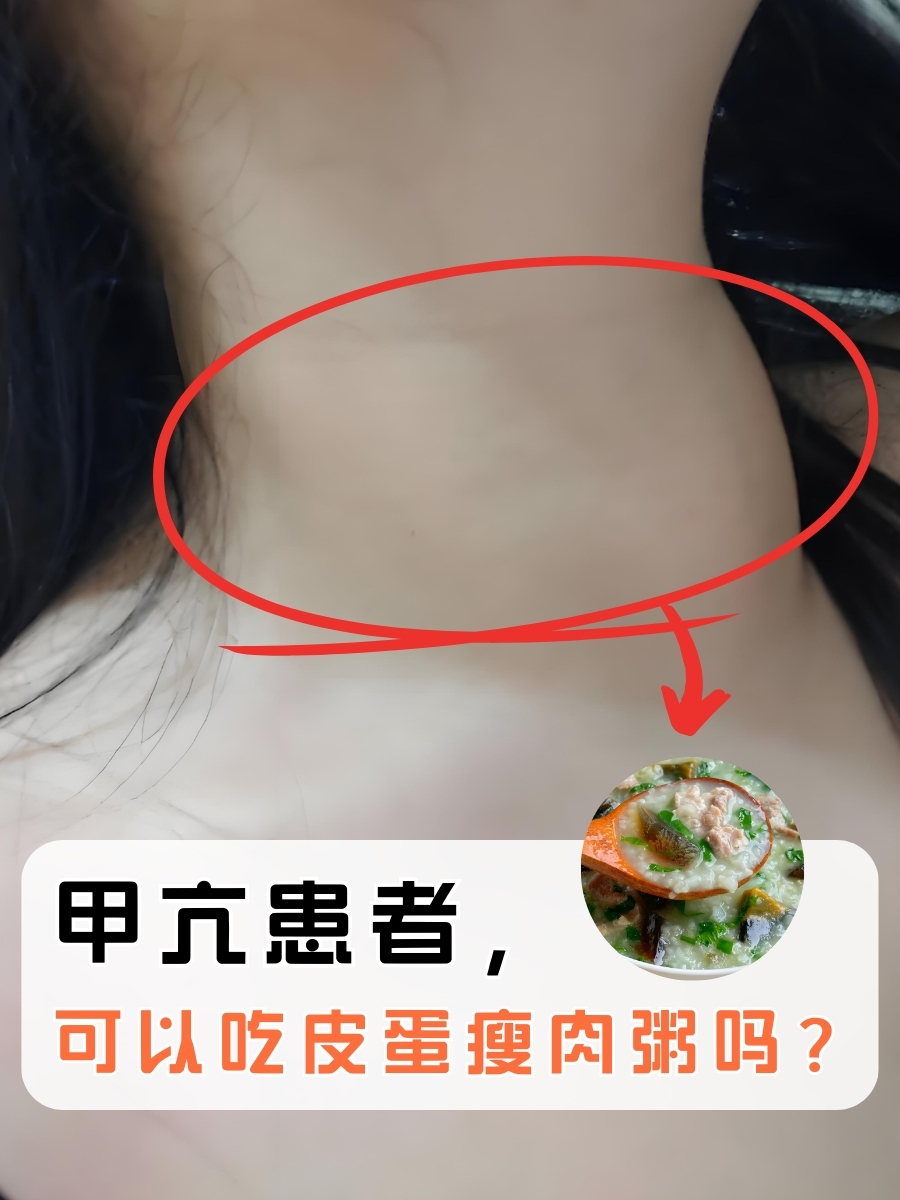 甲亢患者，可以吃皮蛋瘦肉粥吗？