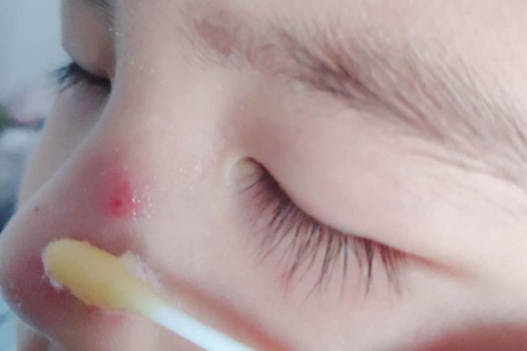 儿童鼻梁上长疖肿图