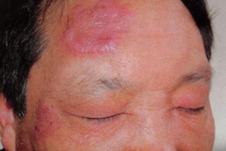 急性发热性嗜中性皮病前额症状图