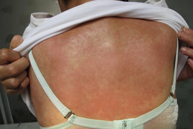 色素性痒疹背部大片红丘疹图