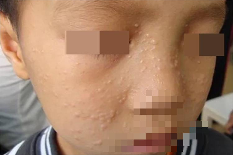 毛发上皮瘤小疙瘩图 毛发上皮瘤小疙瘩图