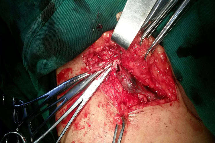 小隐静脉曲张手术图