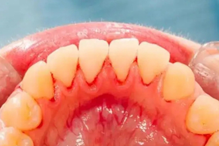 血小板减少性紫癜牙龈症状图 血小板减少性紫癜牙龈症状图