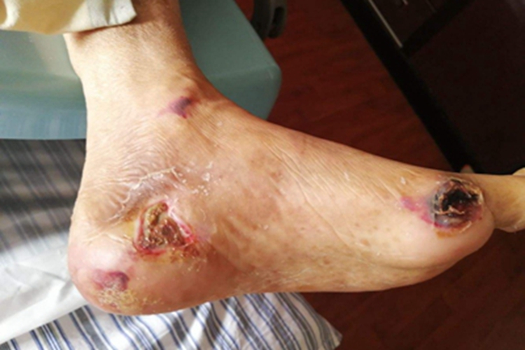 皮肤白喉脚部溃疡图
