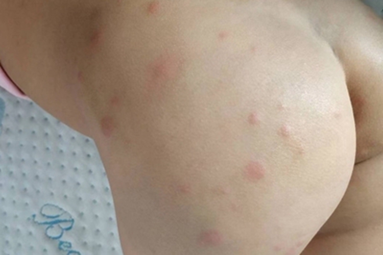 丘疹性荨麻疹臀部疙瘩图 丘疹性荨麻疹臀部疙瘩图