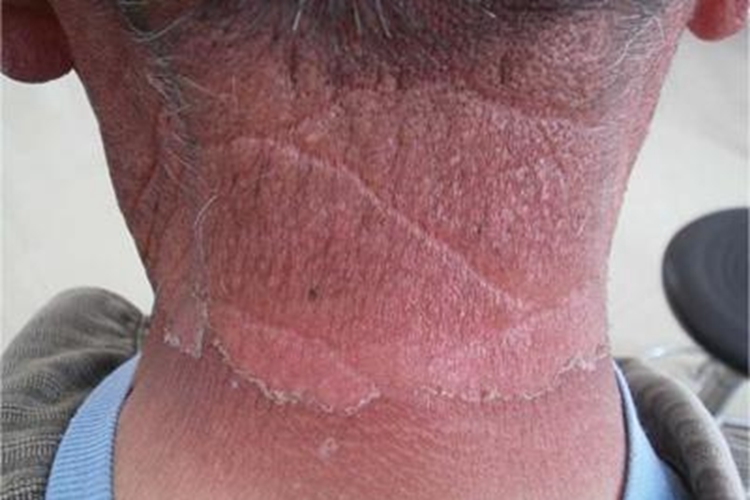 烟酸缺乏症颈后长暗红斑脱皮图 烟酸缺乏症颈后长暗红斑脱皮图