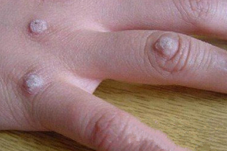 手上尖锐湿疣图 手上尖锐湿疣图