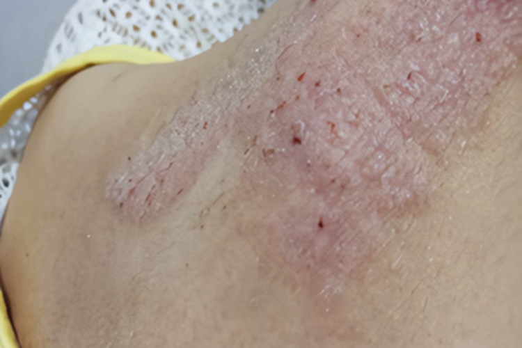 干性湿疹颈部红斑结痂图