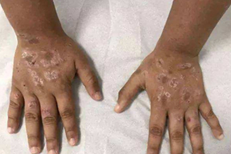 青年成人期特应性皮炎手背斑块图