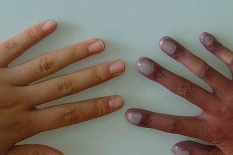 杵状指图 杵状指图