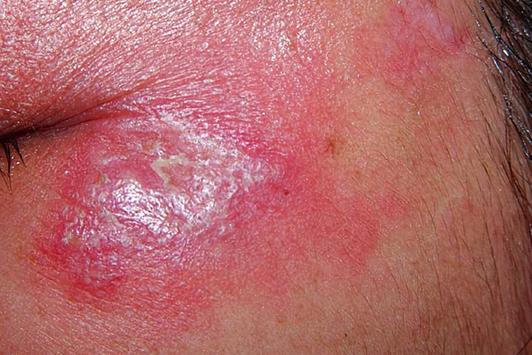 急性发热性嗜中性皮肤病图