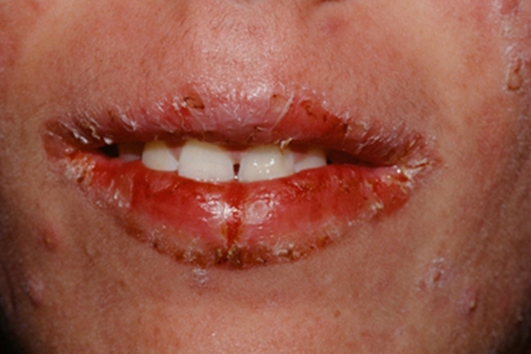 口角炎嘴唇结痂图