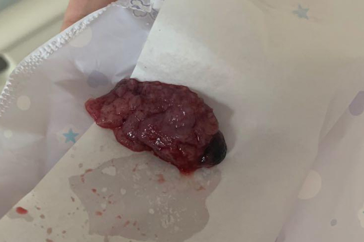 宫外孕保守治疗排出物图 宫外孕保守治疗排出物图