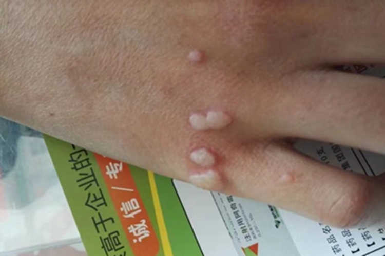 寻常疣手背症状图