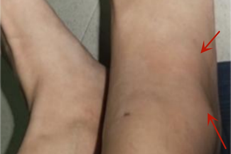 踝扭伤脚踝肿胀明显图