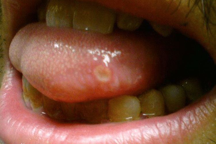 舌头咬破了伤口成溃疡图