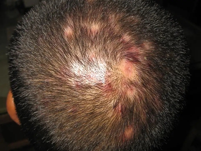 斑秃毛囊炎症状图片图片