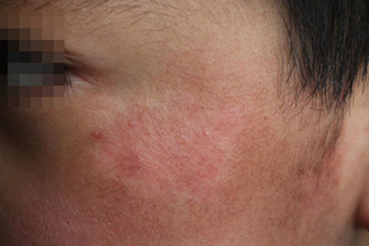 体癣颧骨有凸起的丘疹图 体癣颧骨有凸起的丘疹图