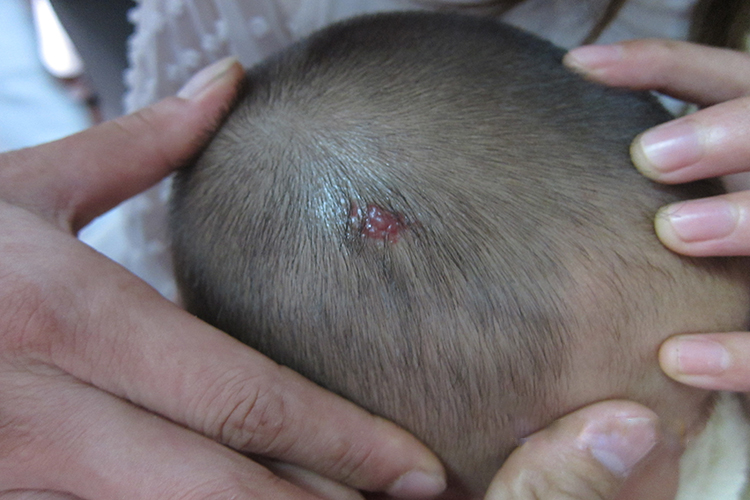 头上血管瘤图 头上血管瘤图