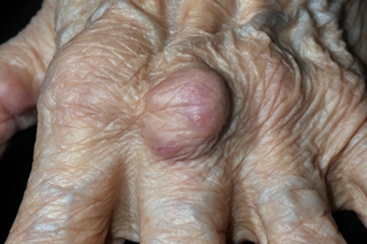 经典型上皮样肉瘤手指症状图 经典型上皮样肉瘤手指症状图