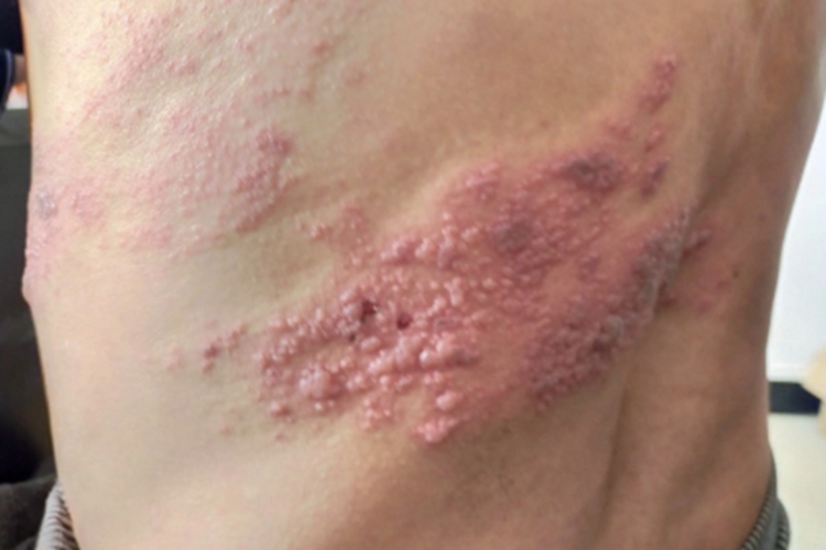 艾滋病感染性皮肤损害背部症状图