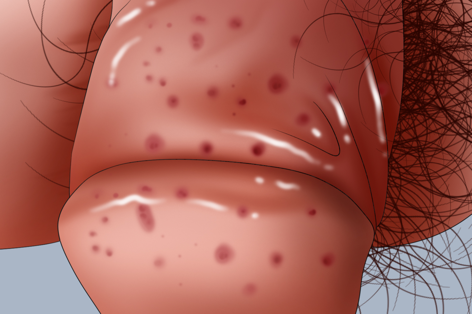 龟头念珠菌感染表面红斑脱屑图