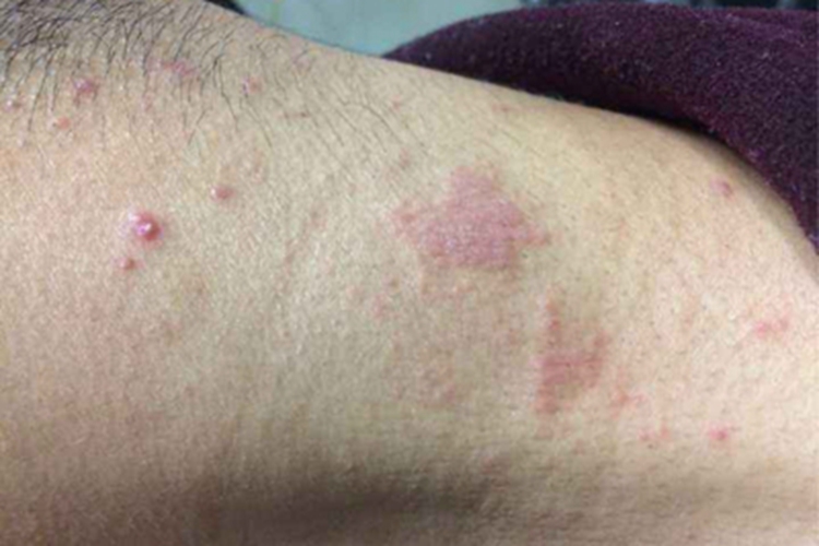 青年成人期特应性皮炎后颈症状图