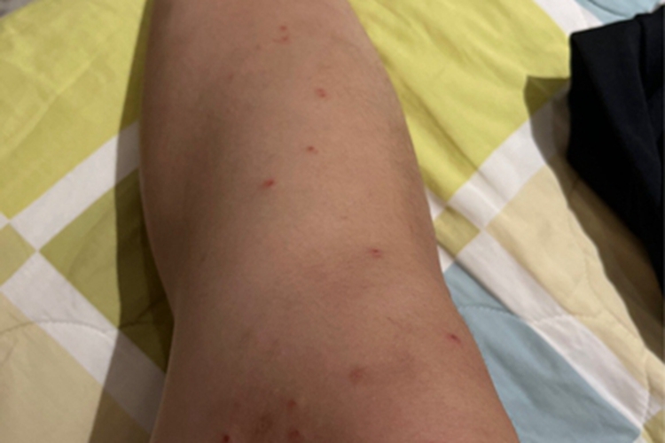 蚊性皮炎小腿有小疙瘩图