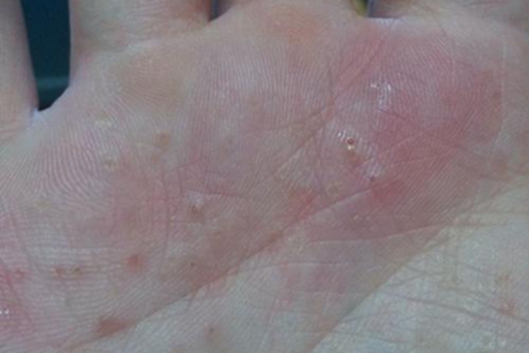 手部湿疹手掌有小圆疙瘩图 手部湿疹手掌有小圆疙瘩图