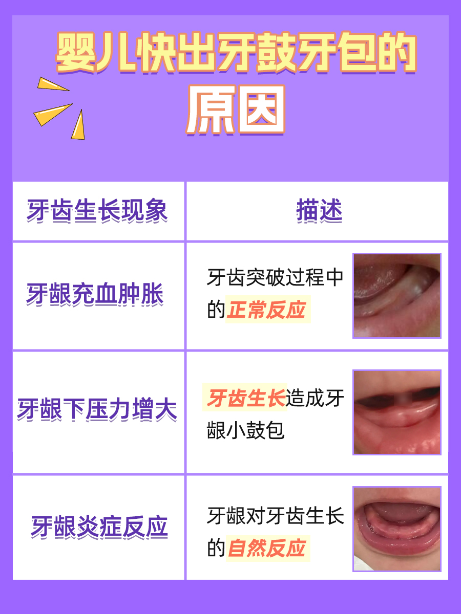 婴儿快出牙鼓牙包图片
