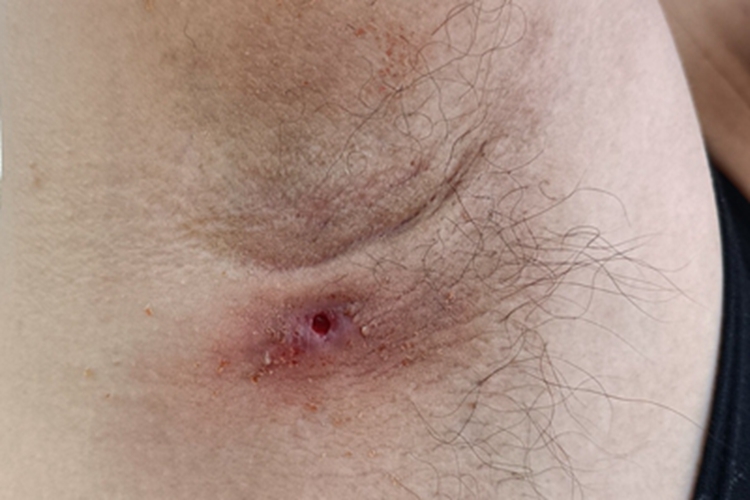 皮脂腺囊肿腋窝红肿图