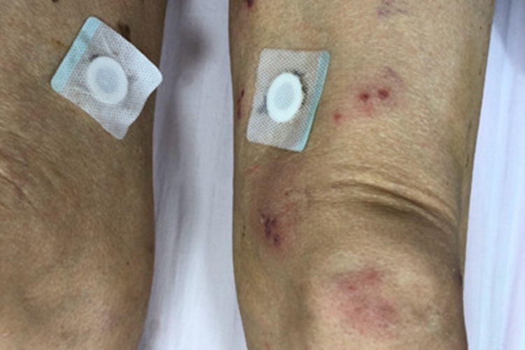 单纯疱疹腿部症状图