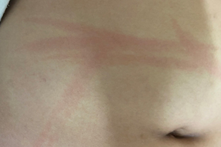 人工荨麻疹红斑图 人工荨麻疹红斑图