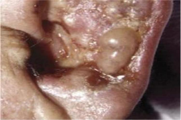 碘疹耳部症状图 碘疹耳部症状图