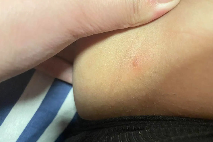 胯下扁平疣图 胯下扁平疣图