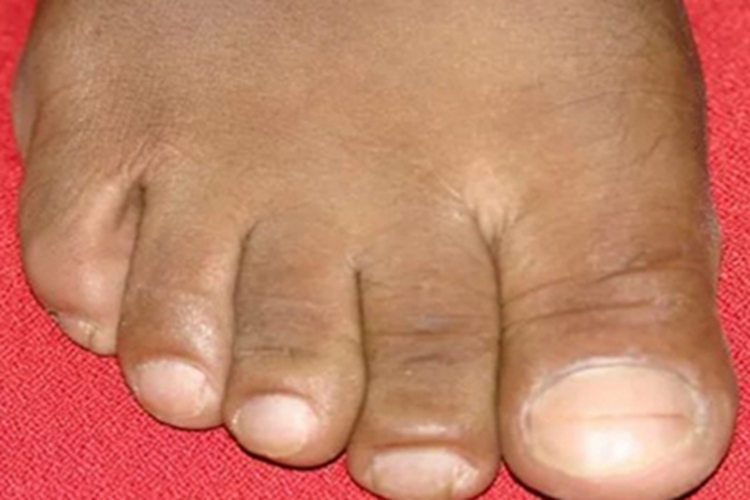 杵状指脚趾甲皮肤增厚图 杵状指脚趾甲皮肤增厚图