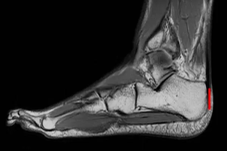 核磁共振跟腱图