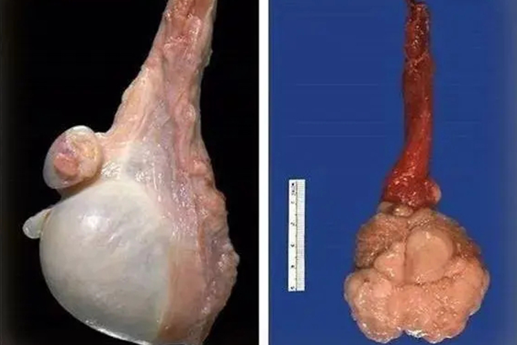 正常睾丸与睾丸癌(右)对比图 正常睾丸与睾丸癌(右)对比图