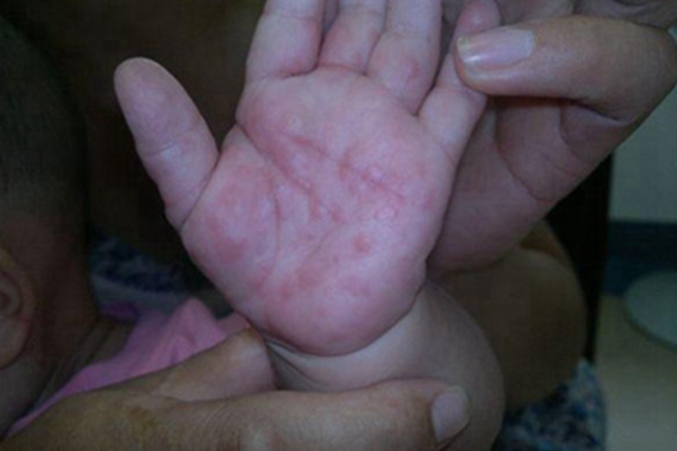 疱疹样皮炎小红疙瘩图 疱疹样皮炎小红疙瘩图