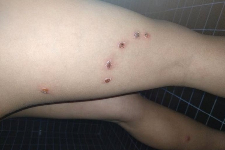 脓疱疮大腿黑痂图 脓疱疮大腿黑痂图