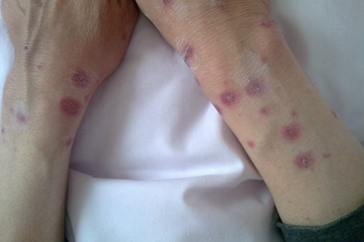 轻型多形红斑型药疹胳膊有红斑图