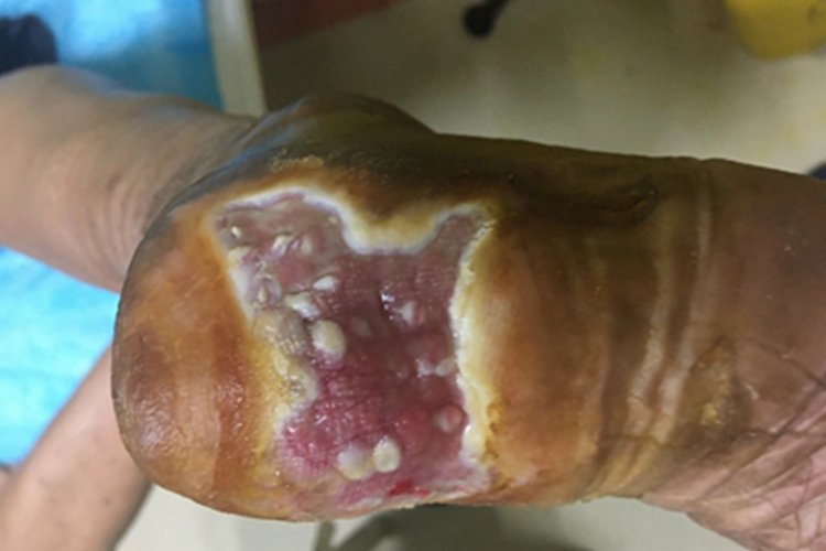 湿性坏疽脚后跟症状图 湿性坏疽脚后跟症状图